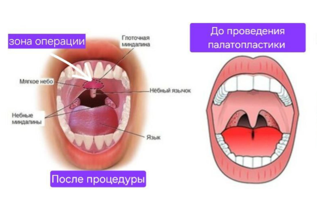 передняя палатопластика в Москве