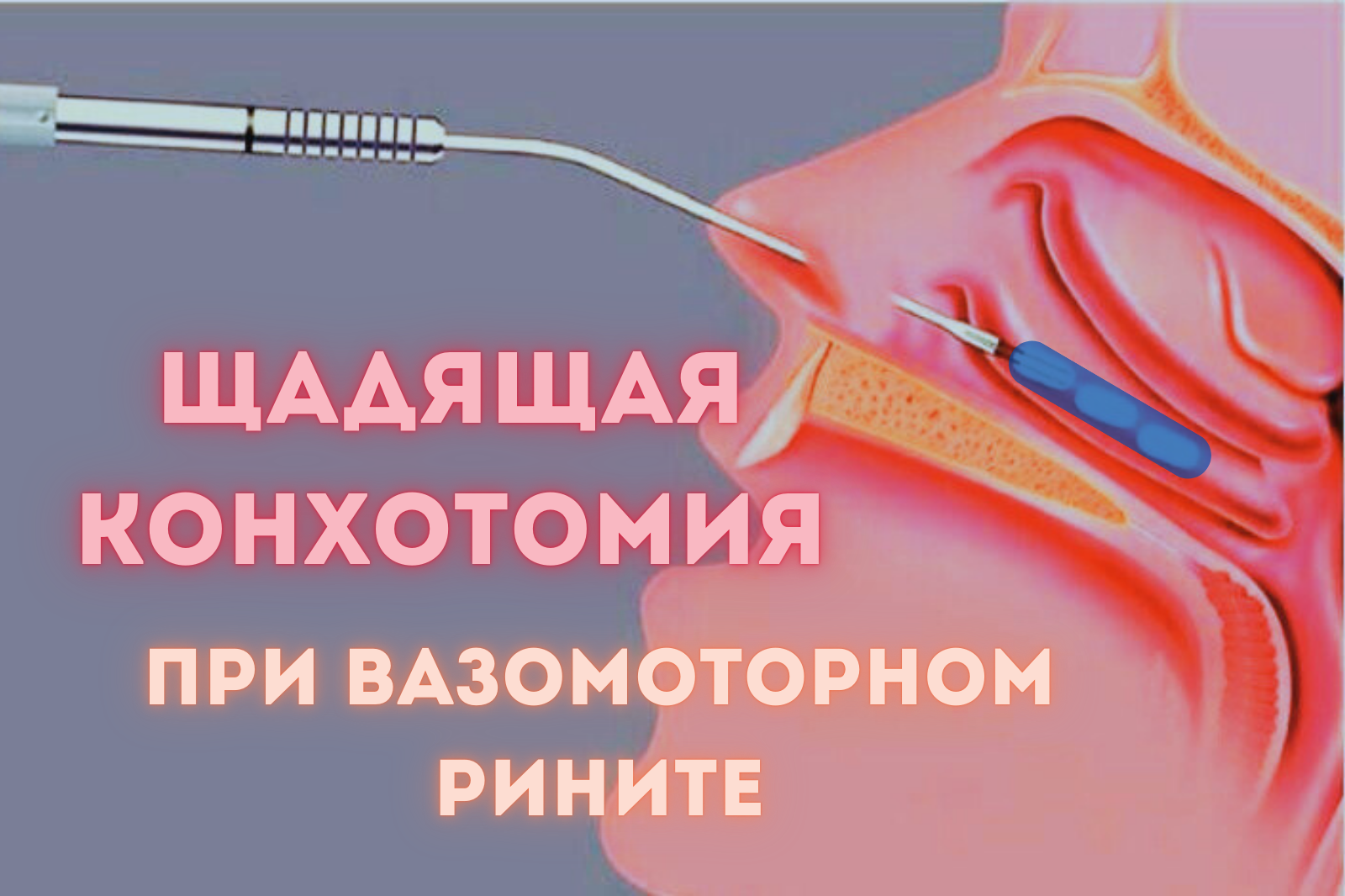 Щадящая конхотомия синим лазером